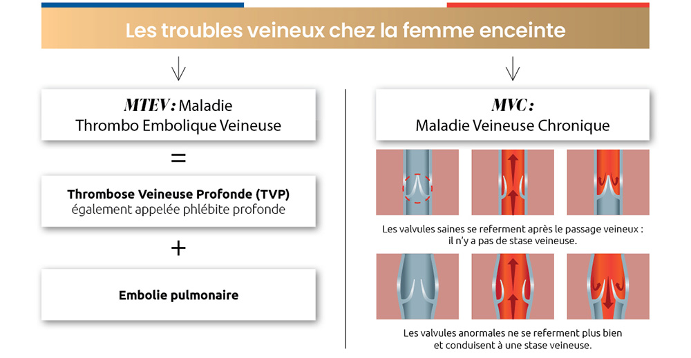 Infographie Troubles veineux